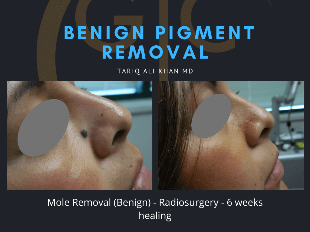 Gentle Care Laser Tustin & Long Beach Before and After picture - Mole Removal